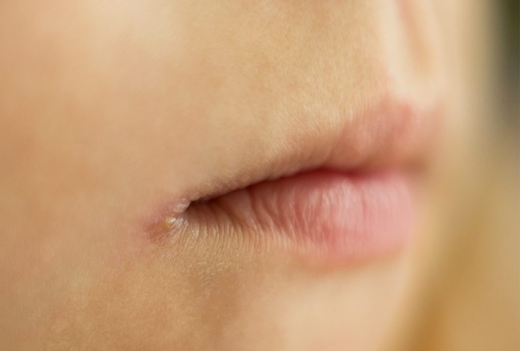 How to Get Rid of Angular Cheilitis